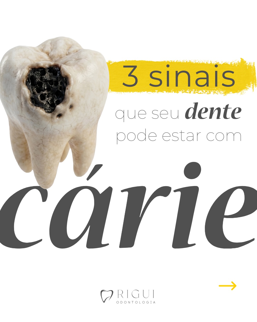 3 sinais de que seu dente pode estar com cárie